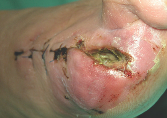 Image showing a diabetic foot ulcer - Image showing a diabetic foot ulcer -